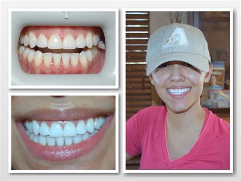 Expert Teeth Whitening In Scottsdale Az Whiten Up Today