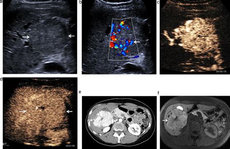 Focal Nodular Hyperplasia An Irregular Shaped Between Arrows