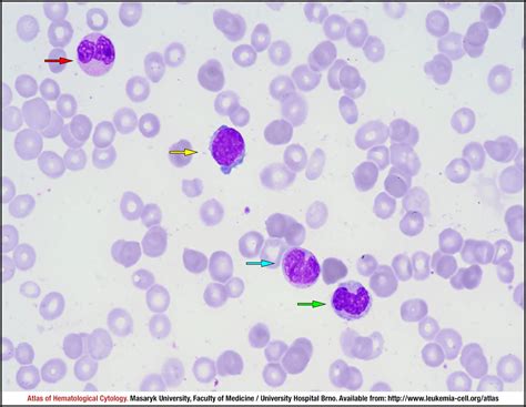 Overt Primary Myelofibrosis Cell Atlas Of Haematological Cytology
