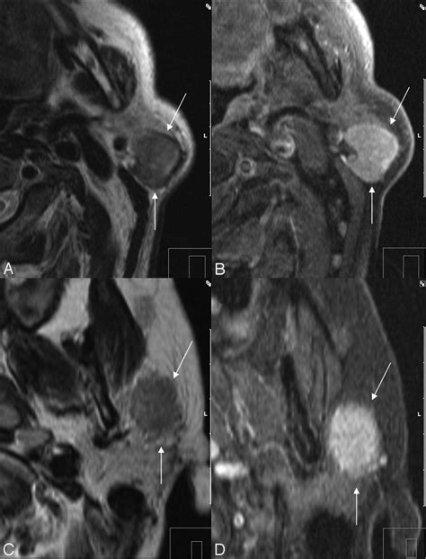 Mr Imaging Of Parotid Tumors Typical Lesion Characteristics In Mr