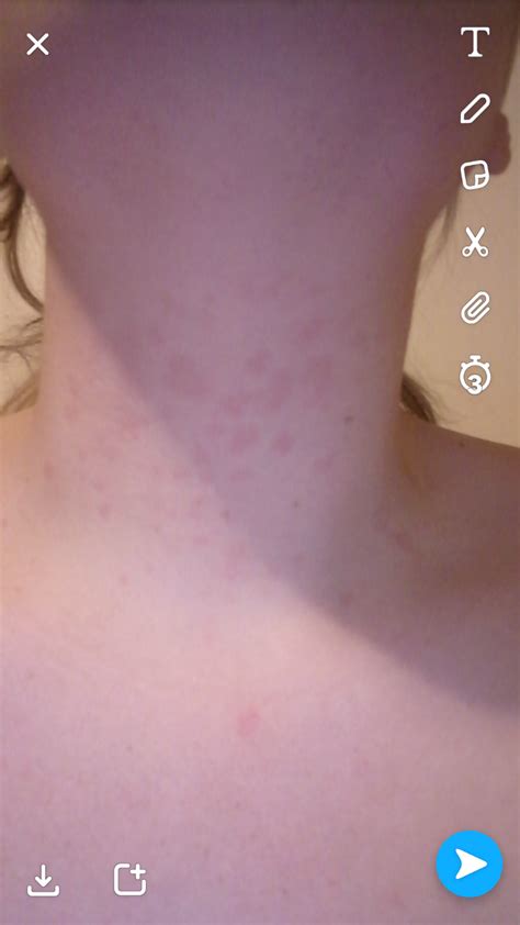 I Have Skin Patches On My Neck And Chest Since I My Teens Could It Be