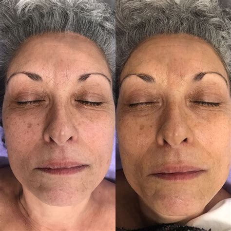 Dermaplaning W Microcurrent Infusion Before And After Dermaplaning