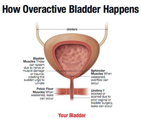 Certain changes in the dna inside normal bladder cells can make them grow abnormally and form cancers. Can't Control Your Pee? There's a Cure for That ...