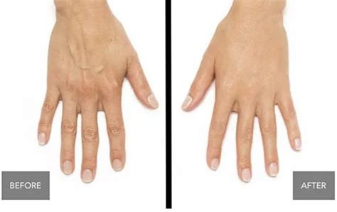 Hand Rejuvenation Treatment Rejuv Spa And Cosmetic Center
