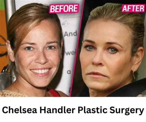 Chelsea Handler Plastic Surgery Unveiling The Truth Celebrity Plastic Surgery