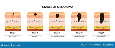 Melanoma Stages Poster Stock Vector Illustration Of Cancer 274843445