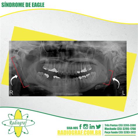 Radiograf Síndrome De Eagle