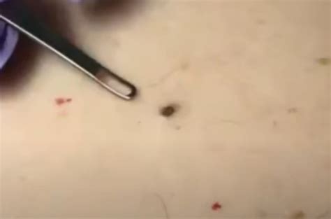 Three Huge Blackheads On The Back Removed New Pimple Popping Videos