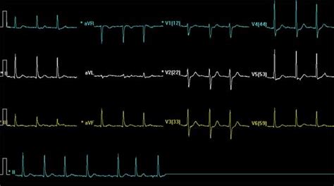 80 Lead Ekg Wikidoc