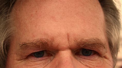 Deep Forehead Wrinkles Mark A Higher Risk Of Dying From Cardiovascular Diseases Nature World News