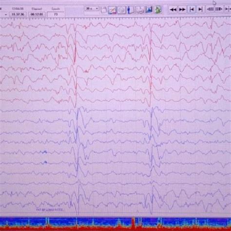 Electroencephalography Eeg Of A Sspe Patient Depicts The Periodic