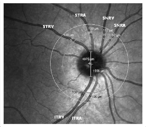 The Method For Retinal Vessel Caliber Measurement Is Shown Stra