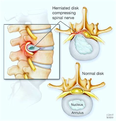 herniated disc compressing spinal nerve herniated disc herniated spinal nerve