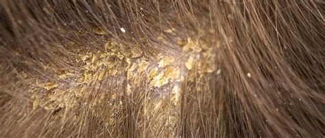 What Are The Good Ways To Cure Scalp Fungus Clocip Cipla