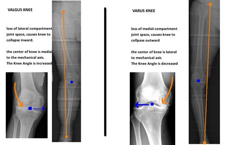 Native Knee Alignment — Hip And Knee Book