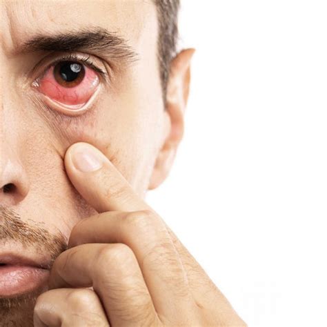 qué es el síndrome de ojo seco y los principales remedios kina fernández
