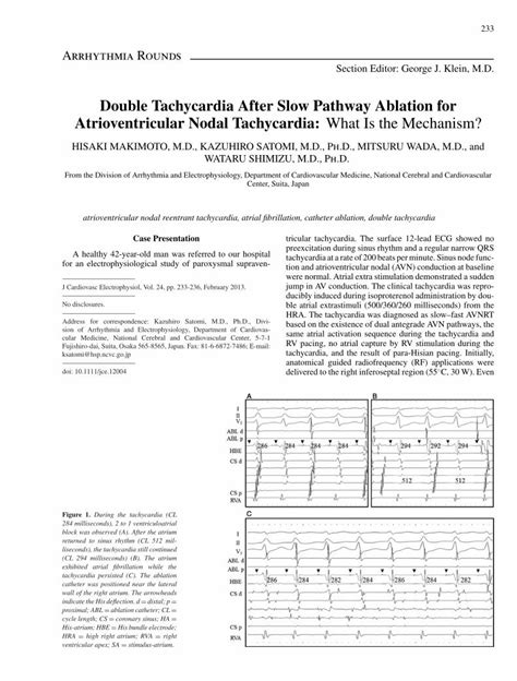 PDF Double Tachycardia After Slow Pathway Ablation For