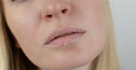 Managing Eczema On Lips Causes And Treatments Clinikally