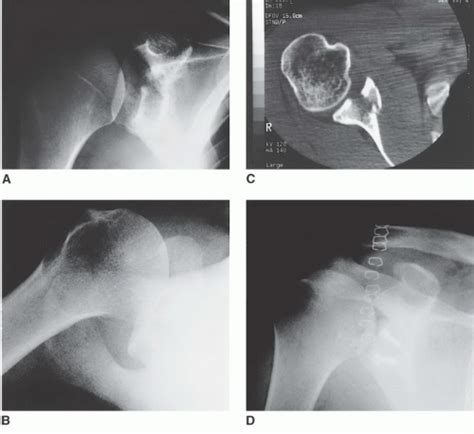 Open Reduction And Internal Fixation Of Glenoid Fractures