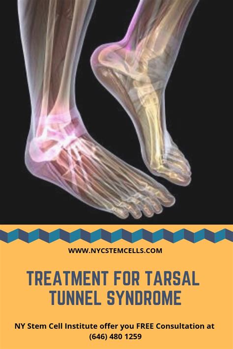 Podiatrists In New York Know What Is Tarsal Tunnel Syndrome And How It