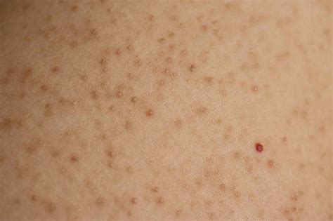 Aha Or Bha For Keratosis Pilaris Which Is Effective Skincare Weeklies