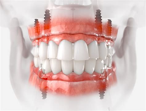 Dental Implant Treatment Process Periodontal Associates Of Memphis
