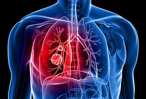 Typical (doubling time of 183 to 365 days): Surprising Lung Cancer Symptoms
