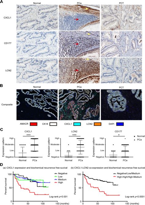 cxcl1 lcn2 paracrine axis promotes progression of prostate cancer via the src activation and