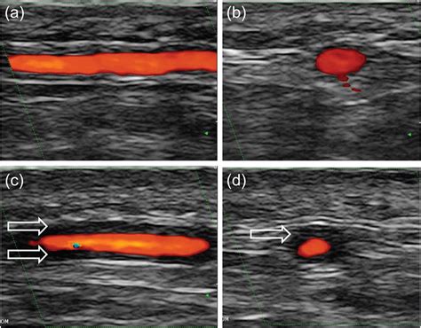 Role Of Ultrasound In The Understanding And Management Of Vasculitis