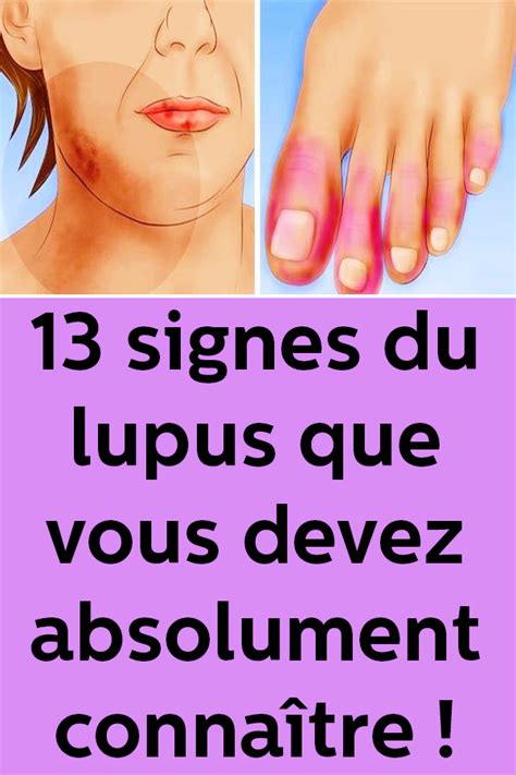 13 Signes Du Lupus Que Vous Devez Absolument Connaître Lupus Signs