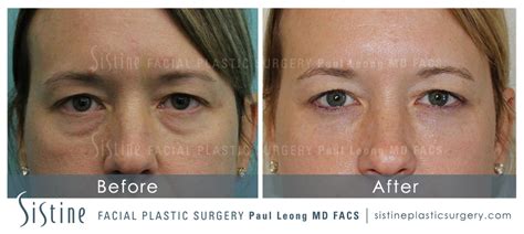 Tear Trough Correction Before And After 20 Sistine Facial Plastic Surgery