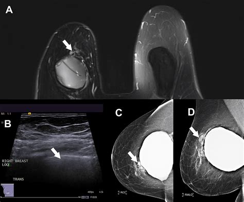 Cureus Free Silicone With Giant Cell Reaction Can Enhance On Breast Mri