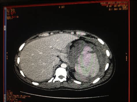 Enhanced Ct Scan Of The Abdomen Transverse Shows The Ruptured Spleen