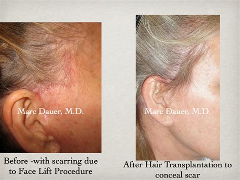 Sideburn Transplant, Hair Transplantation Los Angeles ...