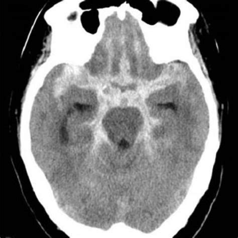 Computed Tomography Ct On Admission Showing Subarachnoid Hemorrhage