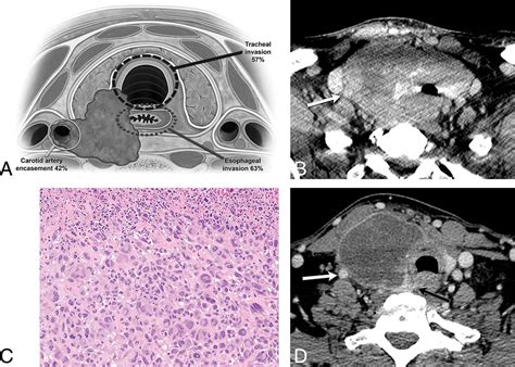 Imaging Of Anaplastic Thyroid Carcinoma American Journal Of