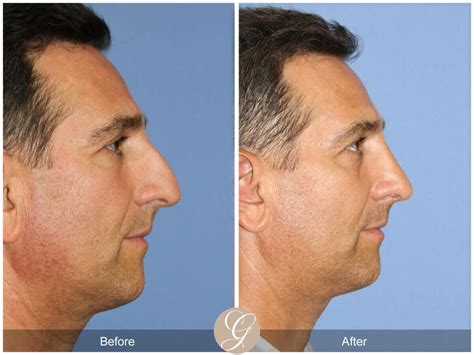 male rhinoplasty newport beach nose surgery dr sadati