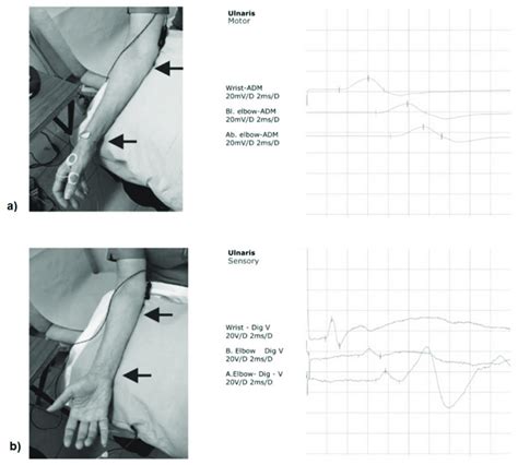 Ulnar Nerve Conduction Velocity A Motor B Sensory Download