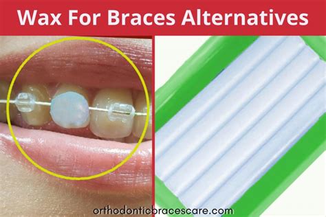 What To Use Instead Of Wax For Braces 5 Alternatives Orthodontic