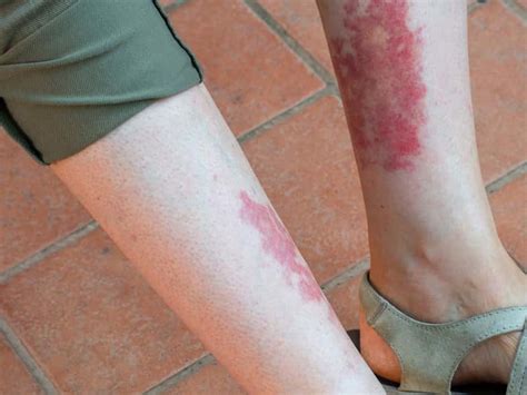 Czerwone Plamy Na Nogach Przyczyny I Leczenie Krok Po Kroku My Xxx