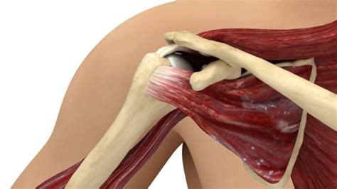 Tendonitis of your shoulder is an inflammation of your rotator cuff or biceps tendon. Subscapularis Muscle : functional anatomy - #shoulder ...