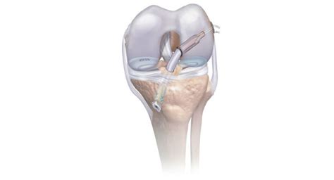Aaos Depuy Synthes Reveals Knee Arthroscopy Platform For Acl And
