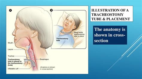 Ppt Nur Skill Performing Tracheostomy Care Powerpoint