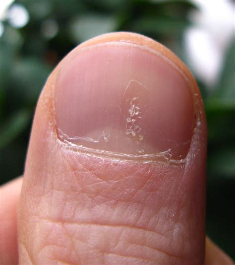 The Ultimate Guide To Understanding And Treating Finger And Toenail
