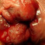 Internal medicine certification examination blueprint purpose of the exam the exam is designed to evaluate the knowledge, diagnostic reasoning, and clinical judgment skills expected of the certified internist in the broad domain of the discipline. Female hemorrhoids photos, pictures of pregnancy ...
