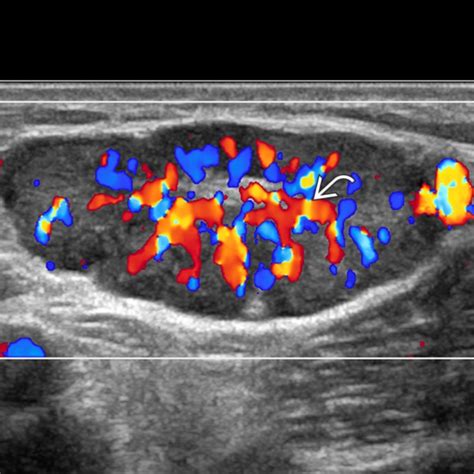 Lymph Node Abnormality Radiology Key