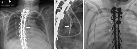 A 20 Year Old Woman Presenting With Central Venous Catheter Malfunction