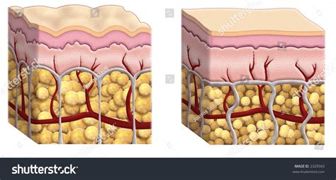 Illustrated Cross Sections Of Skin Showing Fat Distribution In