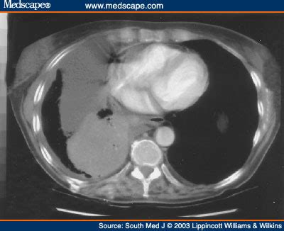 A pleural effusion is an accumulation of fluid within the pleural space. Figures