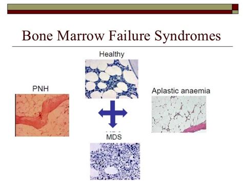 Hypoplastic Bone Marrow Syndromes